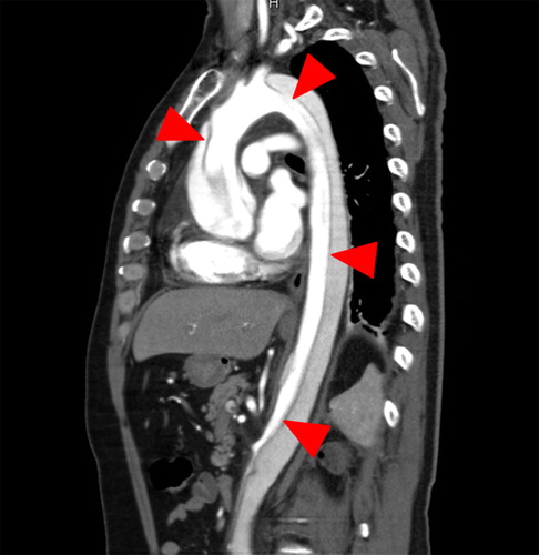 Figure 1. Sagittal reconstruction of a contrast-enhanced computed tomography scan showing an aortic dissection involving the ascending aorta (arrowheads).