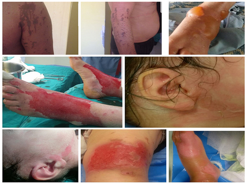 Figure 2 The examples of the acid burns.