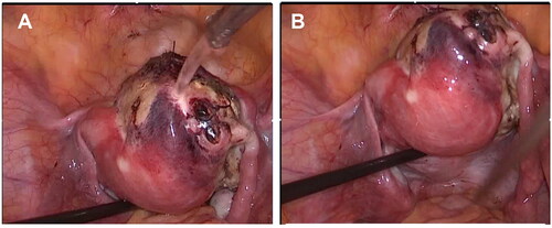 Figure 4. Laparoscope images after ablation. (A) Laparoscope image shows the process of flushing the wound and cleaning the field of vision; (B) Laparoscope image shows the process of checking the condition of the uterus and surrounding organs after ablation.