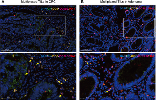 Figure 5 Characterization of the expressions and localization of the co-expression of ICOS, ICOSLG and PD-1 infiltration in CRC and adenoma tissues by using five-color multiplex analysis. (A and B) Representative fluorescence pictures showing ICOS+ICOSLG+PD-1+ TILs protein expression in CRC (A) and adenoma (B) tissues from the clinical cohort. The target signal (co-expression of gold, pink and red fluorescence) is predominantly located in the stroma cells. Nuclei (DAPI, blue), CK (cytoplasm, Opal 520, green), ICOS (cytoplasm, Opal 570, gold), ICOSLG (membrane, Opal 620, pink), PD-1 (cytoplasm, Opal 702, red). Upper panel, Bar scale = 100 μm; lower panel, Bar scale = 50 μm.