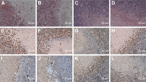 Figure 9 HE staining, apoptosis and PCNA expression of coagulative necrosis in every group.Notes: (A and B) HE staining of coagulative necrosis in tumors in the Lip-ABC group after 3 and 7 d (20×10). (C and D) HE staining in the Lip-PBS group after 3 and 7 d (20×10). (E and F) Apoptosis of coagulative necrosis in tumors of the Lip-ABC group after 3 and 7 d (20×10). (G and H) Apoptosis in the Lip-PBS group after 3 and 7 d (20×10). (I and J) PCNA expression of coagulative necrosis in Lip-ABC group tumors after 3 and 7 d (20×10). (K and L) PCNA expression in the Lip-PBS group after 3 and 7 d (20×10).Abbreviations: HE, hematoxylin–eosin; Lip-ABC, liposomes containing ammonium bicarbonate; d, day; Lip-PBS, liposomes containing phosphate-buffered saline; PCNA, proliferating cell nuclear antigen.