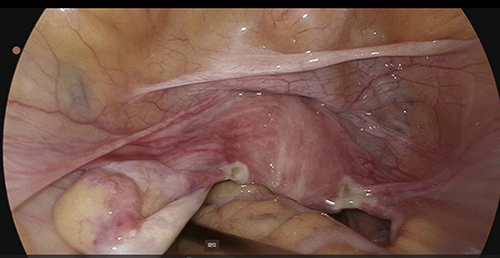 Figure 2 2018.08.05 laparoscopic image.