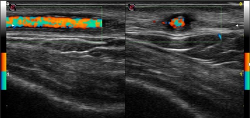 Figure 2 Before treatment, left temporal artery color duplex ultrasonography features before steroid therapy showed a hypoechogenic halo of the temporal artery and the presence of turbulent flow; longitudinal (left) and transverse (right) view.