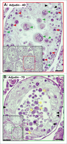 Figure 4. Sloughing of round spermatids (A) and spermatocytes (B) from the seminiferous epithelium of rat testes by 4- and 7-day after a single dose of adjudin (50 mg/kg b.w., by oral gavage). Following the loss of elongating/elongated spermatids which begins to take place in hours following exposure to adjudin, the sloughing of round spermatids (A) and spermatocytes is noted by (B) ∼4D (day) and 7D, respectively. In (A), multinucleate round spermatid cells (green arrowheads), illustrating degenerating germ cells are shown. Spermatocytes (red arrowheads) and Sertoli cells (blue arrowheads) are also noted. In (B), multinucleate spermatocytes (yellow arrowheads), illustrating degenerating spermatocytes (annotated by white arrowhead) are shown. Sertoli cell vacuoles (annotated by black arrowheads) are also noted in both (A) and (B), illustrating Sertoli cell focal injury has occurred. These micrographs are magnified images of the corresponding tubules shown in insets. Scale bars, 40 μm; 150 μm in insets.