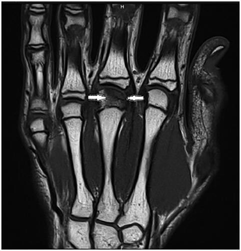Figure 2. First MRI, July 2022. Subchondral fracture of the distal epiphysis of the third metacarpal head, with probable avascular necrosis and preserved viability in T1 weighted images.