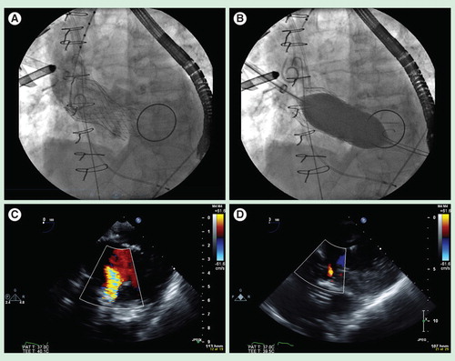Figure 3. Post-implant balloon valvuloplasty represents a commonly performed first-line maneuver to treat severe paravalvular leak. (A) Fluoroscopic image of a 31 mm Medtronic CoreValve Transcatheter aortic valve implantation prosthesis (Minneapolis, MN, USA), implanted via direct aortic access, in a high-risk elderly patient with severe aortic stenosis and a large aortic annulus who had a previous bileaflet mechanical mitral valve prosthesis. (B) Fluoroscopic image demonstrating post-implant balloon valvuloplasty under rapid ventricular pacing with a 28-mm balloon. (C) Intraoperative transesophageal echocardiography demonstrating a deep transgastric view of the CoreValve Transcatheter aortic valve implantation prosthesis, with color Doppler showing severe paravalvular leak post-implantation. (D) Intraoperative transesophageal echocardiography (deep transgastric view) demonstrating resolution of severe paravalvular leak to trace residual aortic insufficiency after post-implant balloon aortic valvuloplasty with a 28-mm balloon.