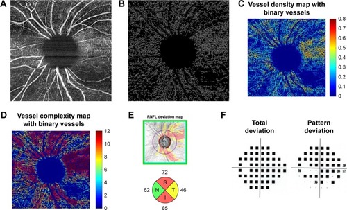 Figure 3 Moderate-severe glaucoma case (A) 6×6 mm2 en face image. (B) Skeletonized vessel image with large vessels removed. (C) Vessel density map with binary vessels, showing areas of higher vessel density in warmer colors. (D) Vessel complexity map with binary vessels, showing areas of greater vessel branching in warmer colors. (E) Cirrus OCT RNFL deviation map (top) and RNFL thickness by quadrant (bottom). (F) Probability total (left) and pattern (right) deviation maps.