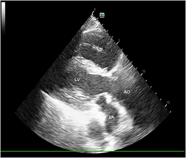 Figure 2 Parasternal long-axis view of transthoracic echocardiography, which was taken from an unusual window at the fourth intercostal space along the mid-axillary line.