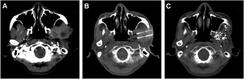 Figure 1 CT images of a recurrent NPC patient.