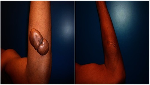 Figure 5 Forearm keloid. Before and after treatment result at 2-year follow-up.