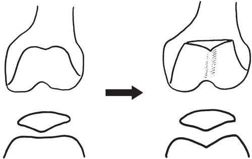 Figure 2. Schema of the modified Dejour technique. After shaving the subchondral bone, an incision from the aspect of the groove was made. A subchondral trench was then cut and the flap undermined, followed by impaction using finger pressure and screw fixation.