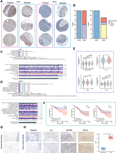 Figure 4 Clinical value of GJA4. (A) Representative immunohistochemistry images of GJA4 and GJA3 in CRC and noncancerous tissues derived from the HPA database. (B) Staining strengths were annotated as not detected, low, medium, and high. Bar plots indicate the number of samples with different staining strengths. (C and D) Correlations between GJA4 level and clinicopathological characteristics in (C) COAD and (D) READ from MEXPRESS. (E) Association of GJA4 mRNA expression with T/N/M stages and pathological stage in CRC patients. (*P < 0.05). (F) OS, DSS, and PFI about GJA4 based on TCGA-COADREAD. (G and H) Representative images of different immunohistochemical staining intensities for GJA4 based on our own samples and statistical comparison of GJA4 expression levels (H-SCORE) in (G) paracancerous and (F) CRC tissue (n = 30). (*P < 0.05, ***P < 0.001).