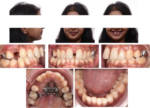 Figure 16 Facial and intraoral pictures after maxillary expansion.