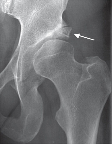 Figure 3. A dysplastic hip, with arrow showing a large os acetabuli or rim fractures.