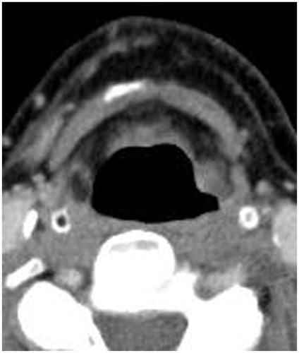 Figure 2. Post-operative CT showing the location of the lesion in the left aryepiglottic fold.