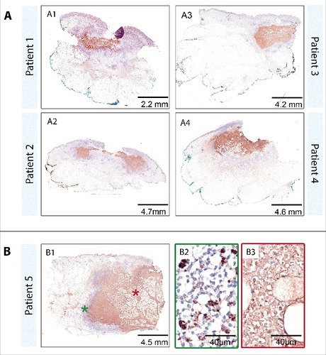 Figure 3. TUNEL staining. The TUNEL protocol allows the staining of low molecular weight DNA fragments typically occurring during apoptosis (brown staining). Sections of patients one to 5 were stained with the “In Situ Cell Death Detection Kit, POD” (Cat. No. 11684817910) from Roche according to the manufacturer's protocol (protocol used was for tissue sections with high unspecific background). Counter stain was done with Haematoxylin. Pictures were either taken with a Leica DFC 420C camera or with an Aperio ScanScope XT. Overview over tissue sections reveals a diffuse staining of the necrotic lesion core (A1-A4, B1) and no staining of the healthy tissue area. Increased magnification (B2, B3) showed a distinct staining of single cells in the belt of infiltrating cells (B1 green star, B2) representing cells currently undergoing apoptosis and a more dispersed staining inside the necrotic core (B1 red star, B3) representing leftover DNA fragments from the initial infiltration. Similar findings were made for all 12 lesions analyzed