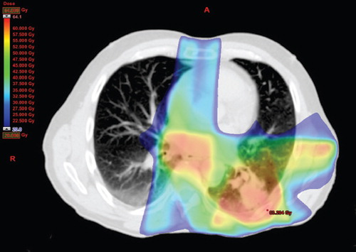 Figure 1. IMRT plan, V20 (Volume of lung receiving at least 20 Gy).