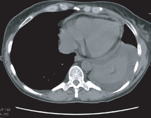 Figure 3 CT scan with moderate pleural effusion and small pericardial effusion in patient with serum-sickness like syndrome. Both effusions rapidly cleared with steroid administration.