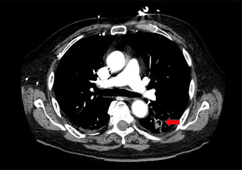 Figure 1 CT chest demonstrating small cavitary lesion in the left lower lobe (arrow).