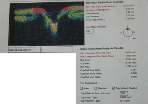 Figure 3 Orientation of the six linear scans of the individual radial scan analysis from the optic disc algorithm of Stratus optical coherence tomography.