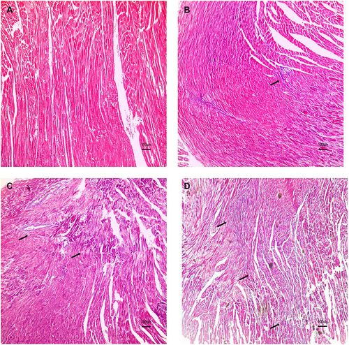 Figure 2 Masson staining of heart tissue 1 month after irradiation and/or PD-1 inhibitors treatment in each group. “↑” shows collagen fibers. (A) Control; (B) PD-1 inhibitors; (C) Irradiation; (D) PD-1 inhibitors + irradiation.
