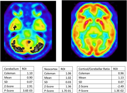 Figure 4. Right Thalamus to Cerebellar Ratio, Region of Interest (ROI) analysis. The right thalamus is pictured on the left. The cerebellum is pictured on the right. The defendant’s right thalamus would appear to be within range for normal metabolic activity, compared to age gender-matched controls, displayed by the absence of black/gray regions. The defendant’s cerebellum appears to be functioning at a higher than normal activity level when compared to age gender-matched controls, displayed by the presence of gray/black regions. However, when taking the ratio of the right thalamus to cerebellar activity, the defendant has a significant (P-score ≤ 0.05) decreased ratio of activity compared to age, gender-matched controls. Decreased activity in the thalamus is evidence of FAS.