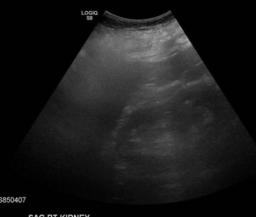 Figure 1. Right renal US shows no hydronephrosis, overall unremarkable