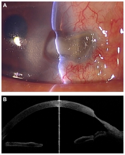 Figure 2 Slit-lamp photograph and anterior optical coherence tomography after discontinuing systemic steroid treatment. (A) Scleral and corneal bed at the site of pterygium excision showing substantial thinning and active surrounding conjunctival inflammation. (B) Anterior optical coherence tomography also showed major corneoscleral thinning.