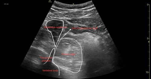 Figure 3 Transmuscular quadratus lumborum block. The image shows the site of injection (white arrow), quadratus lumborum muscle, psoas major muscle, transverse process and the vertebral body.