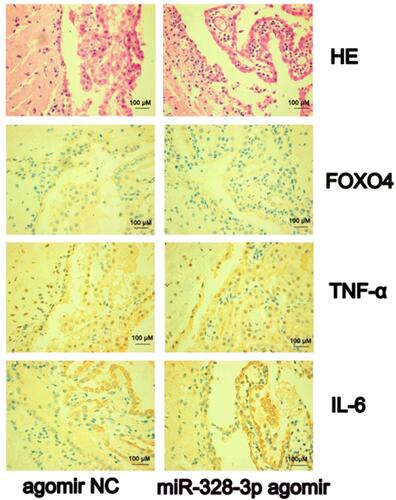Figure 4 H&E and immunohistochemical staining of FOXO4, TNF-α, and IL-6 (400×) in rat brain (n=3, each group). After 24 h of I/R, obvious cell edema, apoptosis and necrosis were seen in the infarct focus. The obvious proliferation of glial cells was seen around the infarct. Moreover, the choroid plexus structure was loose, and the intercellular space was enlarged. The choroid plexus epithelial cells were highly edema, the vascular endothelial cells were swollen, part of the vascular endothelium was broken, and the structural integrity of the choroid plexus was destroyed. The neutrophil infiltration in the agonist group was more serious compared with the control group. The expression of FOXO4 in the miR-328-3p agomir group was lower compared with the agomir NC group (P=0.03). On the contrary, the expressions of TNF-α and IL-6 in the MCAO model from the miR-328-3p agomir group were higher compared with the agomir NC group, while the difference was not statistically significant (P=0.1, P=0.1).
