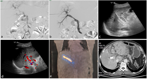 Figure 2 A 68-year-old male HCC patient with mPVTT underwent 125I seed strand (30 seeds) implantation inside the portal vein stent. The patient underwent transarterial chemoembolization (TACE) 20 days later and died 6 months after the 125I seed strand and portal vein stent implantation because of liver failure caused by progression of the tumor. (a) Portography shows a large filling defect in the main portal vein and the right branch of the portal vein with near-complete obstruction of the portal venous blood flow. (b) Portography after deployment of the portal vein stent shows restored blood flow in the main portal vein and the right branch. (c and d) Ultrasound images showing a portion of the 125I seed strand in the liver parenchyma and the blood flow in the patent portal vein stent. (e) SPECT imaging shows homogeneous radiation dose distribution from the 125I seed strand covering the range of the tumor thrombus. (f) Follow-up computed tomography at 3 months after the procedure shows the 125I seed strand inside the stent without displacement, with steady blood flow in the stent.
