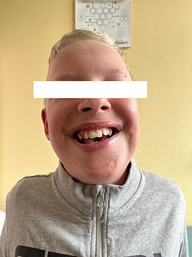 Figure 2 Photograph of the face of the patient with 2p15 microdeletion syndrome – front view. Note characteristic features: broad nasal bridge, smooth philtrum, large mouth, full lips.
