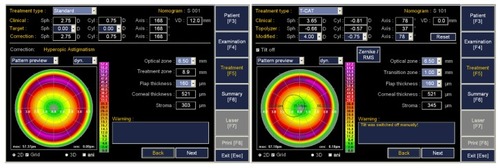 Figure 2 Concept of topography-guided ablation.