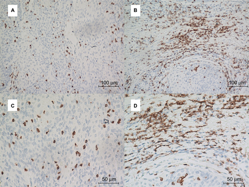 Figure S4 Representative immunohistochemical staining of CD8+ T cells in ASCC.Notes: PD-L1 staining is analyzed at the intratumoral (A and C) and peritumoral locations (B and D). Top row: ×200 original magnification; bottom row: ×400 original magnification.Abbreviations: ASCC, anal squamous cell carcinoma; PD-L1, programmed death-ligand 1.