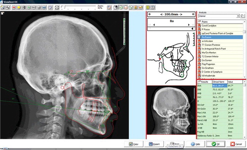 Figure 1. General layout of the Vista Dent OC software showing the cephalometric analysis.