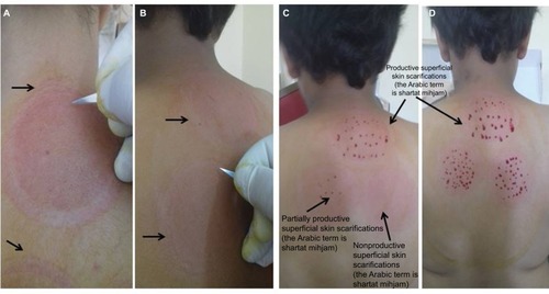 Figure 2 Skin scarification step (superficial skin scarifications; the Arabic term is shartat mihjam) to open the intact skin barrier and enhance dermatological excretion. Notes: (A) Line of demarcation of the skin upliftings after removal of the cups of the first sucking step. (B) Handling the scalpel for skin scarification is similar to holding a pen. Scarifications should be superficial scratches. The golden standard when making scarifications is to touch but never cut the skin. (C) Superficial skin scarifications (the Arabic term is shartat mihjam) should be productive to get optimal excretory function and therapeutic benefits after Al-hijamah (wet cupping therapy of prophetic medicine). Superficial skin scarifications (the Arabic term is shartat mihjam) should not be nonproductive or partially productive. (D) Productive shartat mihjam is the Arabic term given to the superficial skin scarifications (~0.1 mm in depth that preserves the structure of the superficial fenestrated dermal capillaries) that are confined to the skin dome (skin uplifting created after the first suction step). Skin scarifications of Al-hijamah denote the hand skills that differentiate one skillful practitioner from another. Skin scarifications should be multiple, longitudinal (~1–2 mm in length, ie, not pinpoint pricks), in parallel rows, equally distributed and productive.