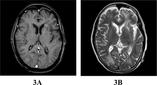 Figure 3 MR on June 29: multiple ring-enhancing lesions were still found in the bilateral cerebral and cerebellar hemispheres, which had shrunk significantly. (A) T1 enhancement sequence showed multiple circular enhancement lesions on both sides of the brain, marked perifocal edema, uniform, smooth ring wall, and ring-enhancement. (B) The T2 sequence shows that the lesion has a high signal, with significant surrounding edema.