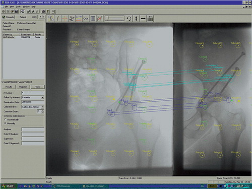 Figure 20. The markers in the illiac bone and the markers in the acetabular fragment are detected and connected on the two radiographs in the RSA-CMS software package. The RSA image consists of two image halves on which the same object can be seen but at different angles.