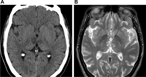 Figure 3 (A) Brain CT scan axial view, performed after thrombolysis showing ischemic stroke in the paramedian territory of both thalami. (B) MRI axial view seq T2.