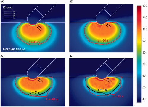 Figure 5. Temperature distribution (°C) and thermal lesions created in cardiac tissue with the catheter at 45° to the tissue by a standard ablation protocol of 20 W–45 s (A) and 30 W–30 s (B), and also a HP-SD ablation protocol of 70 W–7 s (C) and 90 W–4 s (D). The thermal lesion was assessed by the Arrhenius contour Ω = 1 after the RF ablation time (red solid line in A and B and black solid line in C and D together with ablation time) and after the extra thermal expansion caused by thermal latency in the cooling period (red solid line in C and D together with the minimum time required to reach it).