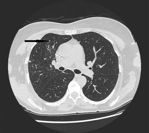 Figure 4. 72-year-old woman with acute myeloid leukemia presenting with fever. High- resolution CT scan obtained at level of main bronchi shows micronodules and nodules located peripherally in middle right lobe (black narrow arrow).
