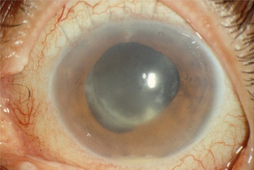 Figure 2 Delayed-onset (chronic) postoperative endophthalmitis (note the small hypopyon and peripheral intracapsular infiltrates).