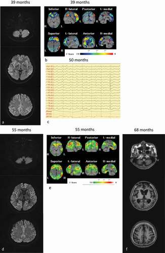 Figure 1. MRI, single photon emission computed tomography (SPECT) and electroencephalography of the patient. (a): Diffusion-weighted MRI (DW-MRI), and (b): SPECT images obtained 55 months after onset; (c): Electroencephalography obtained 50 months after onset; (d): DW-MRI, and E: SPECT images obtained 55 months after onset; (f): T1-weighted MRI obtained 68 months after onset. The eZIS analysis of SPECT images revealed decreased regional cerebral blood flow (rCBF). A higher Z-score indicated a lower rCBF. A Z-score of 2 to 6 is indicated by the green or black-to-red (lower rCBF) colour gradient. Panel A shows the bilateral hyperintense lesions in the frontal, temporal, and parietal cortices, and the basal ganglia. Panel B depicts the decreased rCBF in the frontal and parietal lobes. Panel C depicts the periodic sharp wave complexes. Panel D depicts bilateral hyperintensity in all cortices, and panel E shows preserved rCBF in the brainstem. Panel F depicts progressive cerebral atrophy, but no brainstem atrophy