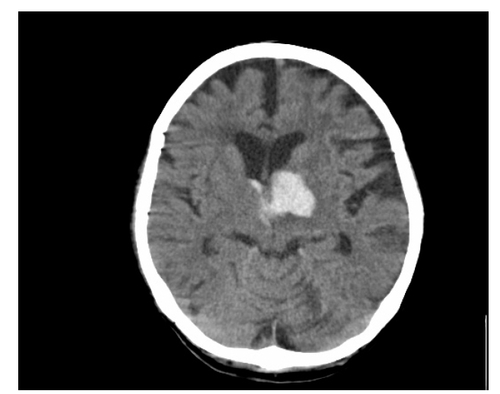 Figure 1 CT scan showing hemorrhage in the left thalamus secondary to hypertension.