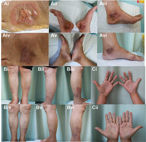 Figure 1 A female patient with pyoderma gangrenosum, plaque psoriasis and palmoplantar pustulosis who is treated with adalimumab. Lesions of (Ai–Aiii) pyoderma gangrenosum, (Bi–Biii) plaque psoriasis and (Ci) palmoplantar pustulosis were significantly improved (Aiv–Avi, Biv–Bvi and Cii) after 3 months by treating with adalimumab.