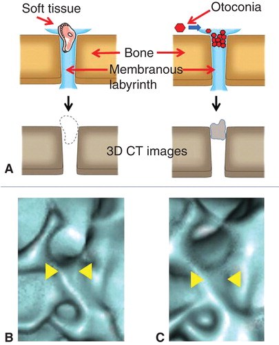 Figure 1. Strategy of 3D CT images for assessing the patency of the bony groove in which the membranous labyrinth lodges. When the non-radiodense substances such as soft tissue dislodges on the membranous labyrinth on the bony groove, the 3D CT image shows the continuity of the bony groove (A, left), but in case of the radiodense substances such as otoconia, the 3D CT image loses the continuity of the bony groove (A, right). (B) 3D CT images of the reuniting duct of cadaver specimen treated with meat fragments and (C) that treated with CaCO3. Note the differences in the continuity of the bony grooves (yellow arrowheads).