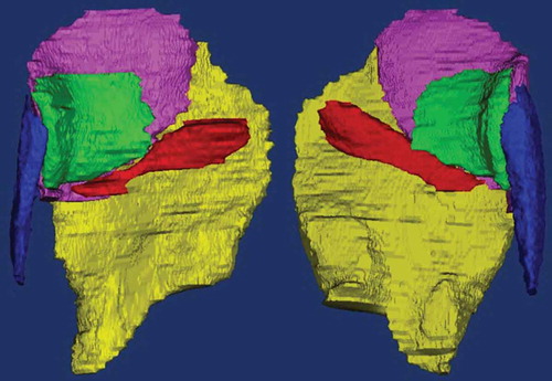 Figure 5. Final 3-D reconstruction hip abductor muscles of the residual limb (left) and sound limb (right) at baseline. Note: M. gluteus maximus (yellow), m. gluteus medius (purple), m. gluteus minimus (green), m. piriformis (red) and m. tensor fasciae latae (blue).