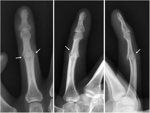 Figure 2. Plain radiographs of the left fourth digit reveal cortical irregularity at the level of the fused PIP joint (arrows) and adjacent soft tissue swelling.