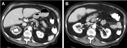 Figure 5 (A) Segmental XGP affecting the upper pole of the right kidney showing infiltrated calyces centred on a staghorn calculus in a bear-paw configuration (Elder & Malek Stage 1 disease). (B) Entirely normal lower pole moiety in the same patient.