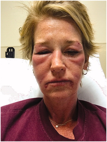 Figure 1. One month after the hyaluronic acid filler injection, patient developed a facial hypersensitivity reaction consisting in facial edema, erythema, itchiness and mild fever.